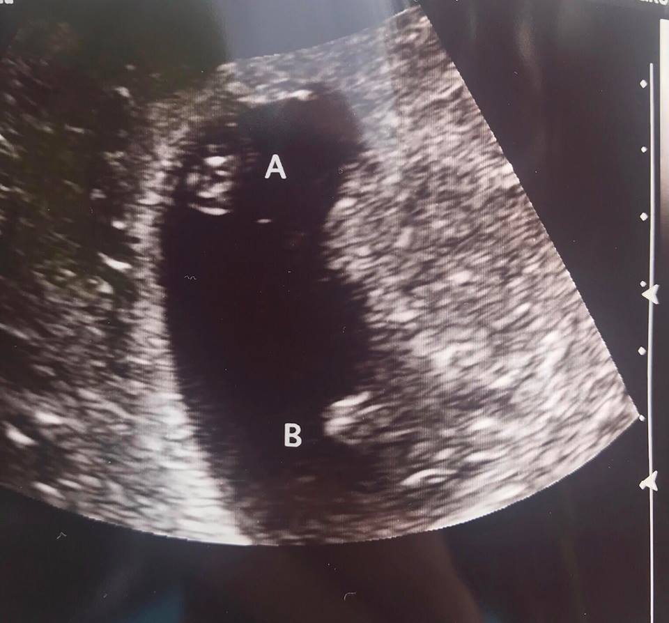 Mono Di twin ultrasound 7 weeks