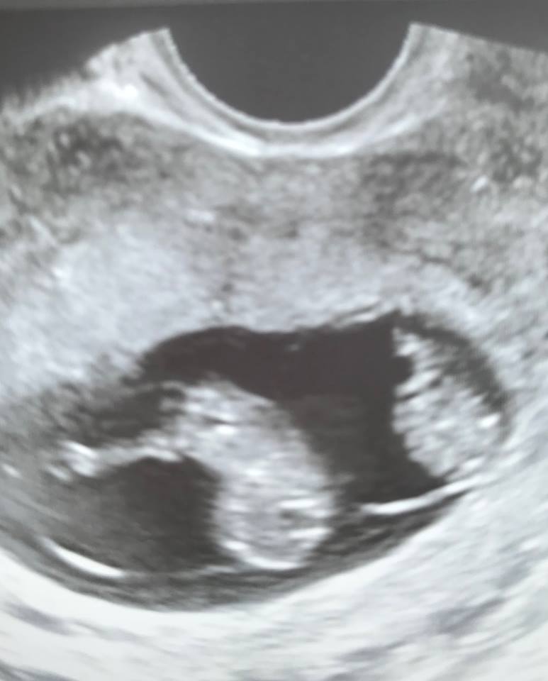 Mono di twin ultrasound 9 weeks